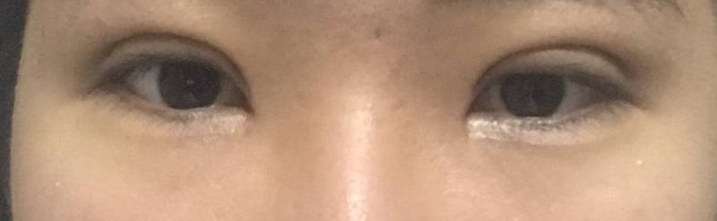 쌍수한 익들아 나 쌍수 붓기 좀 봐주라 ㅠㅠ 진짜 고민이야 | 인스티즈