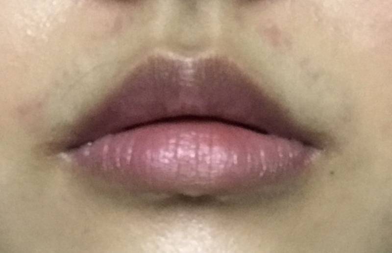 레이저 제모 원래 이래?!?! | 인스티즈