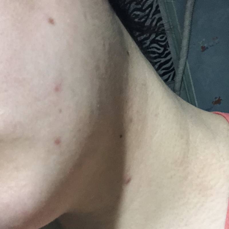 우어어 일년 동안 목 여드름 많이 나았다 ㅠㅠ | 인스티즈