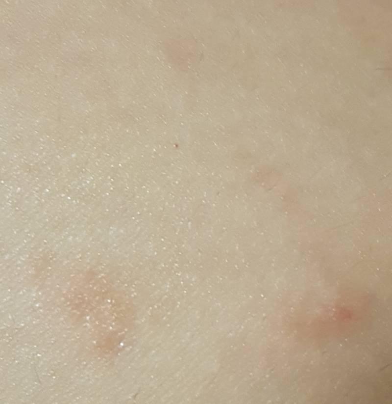 다리에 이런게 생겼는데 뭘까ㅠㅠ | 인스티즈