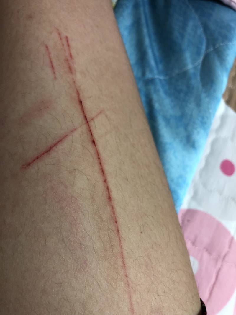 혐오주의) 다리에 이렇게 상처가 날 일이 머가 있을까 | 인스티즈