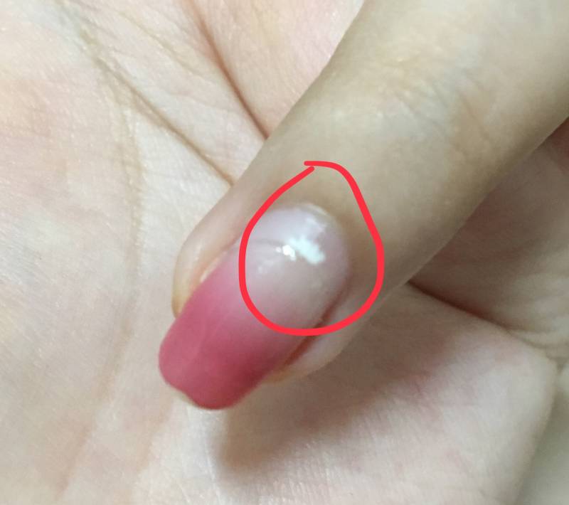 손톱에 이런거 왜 생기는거야...? | 인스티즈
