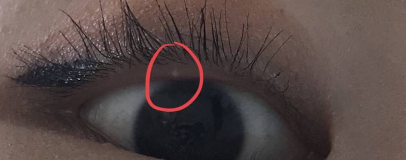 점막에 뭐 낫는데 이거 뭐야???ㅠㅠㅠㅠㅠ | 인스티즈