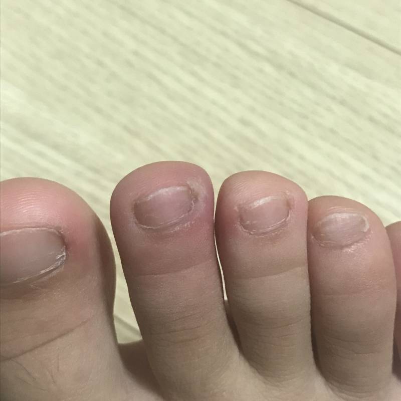 고름 나가지고 짯는데 이 정도몈 된 거야? 도와줘ㅜㅠ | 인스티즈