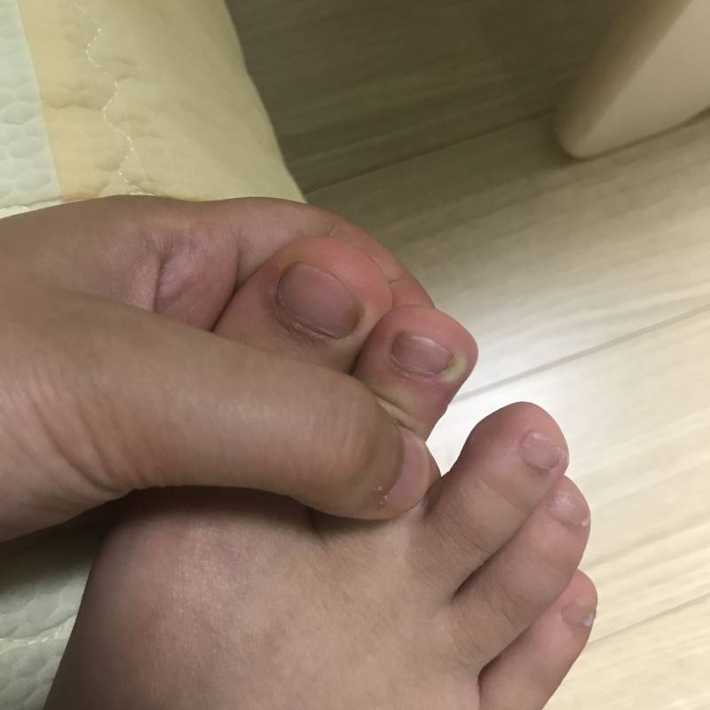 고름 나가지고 짯는데 이 정도몈 된 거야? 도와줘ㅜㅠ | 인스티즈