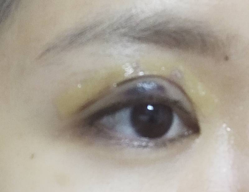 쌍수햇는데 라인 마음에 든댱(혐오주의) | 인스티즈