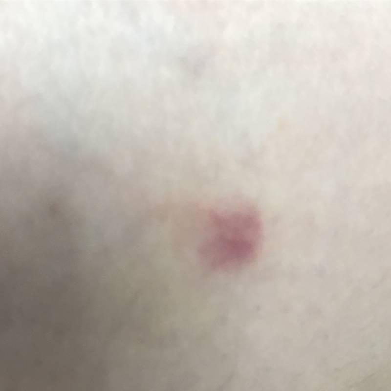 허벅지에 이런게 있는데 벌레 물린건가 | 인스티즈