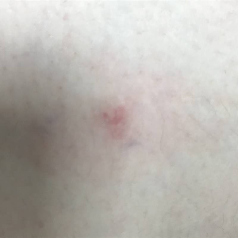 허벅지에 이런게 있는데 벌레 물린건가 | 인스티즈