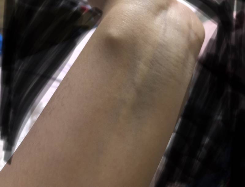 팔목에 혹같은거 생겼어 | 인스티즈