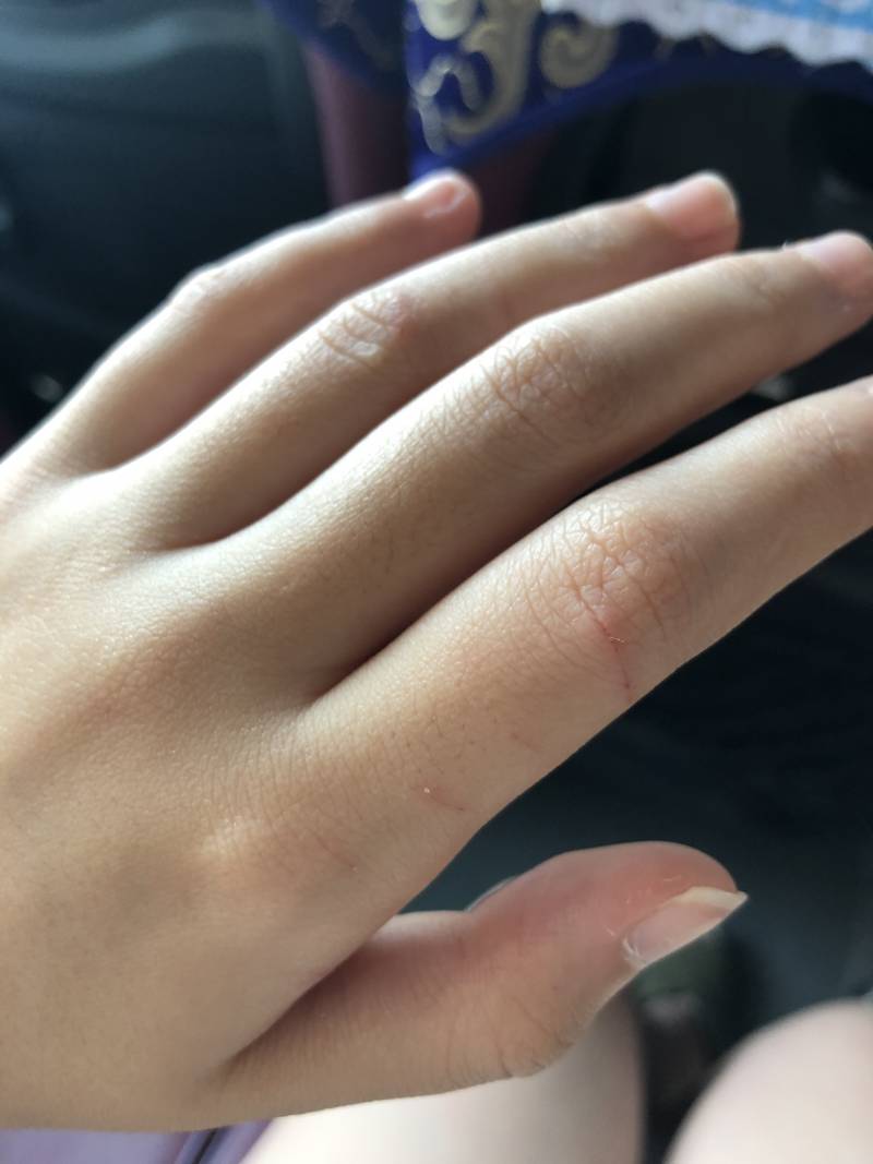 길고양이한테 이렇게 할큄당했는데 ㄱㅊ겠지...? | 인스티즈