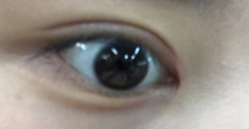 쌍수 두달차인데 도와줘 ㅠㅠㅠㅠㅠㅠㅠㅠ | 인스티즈