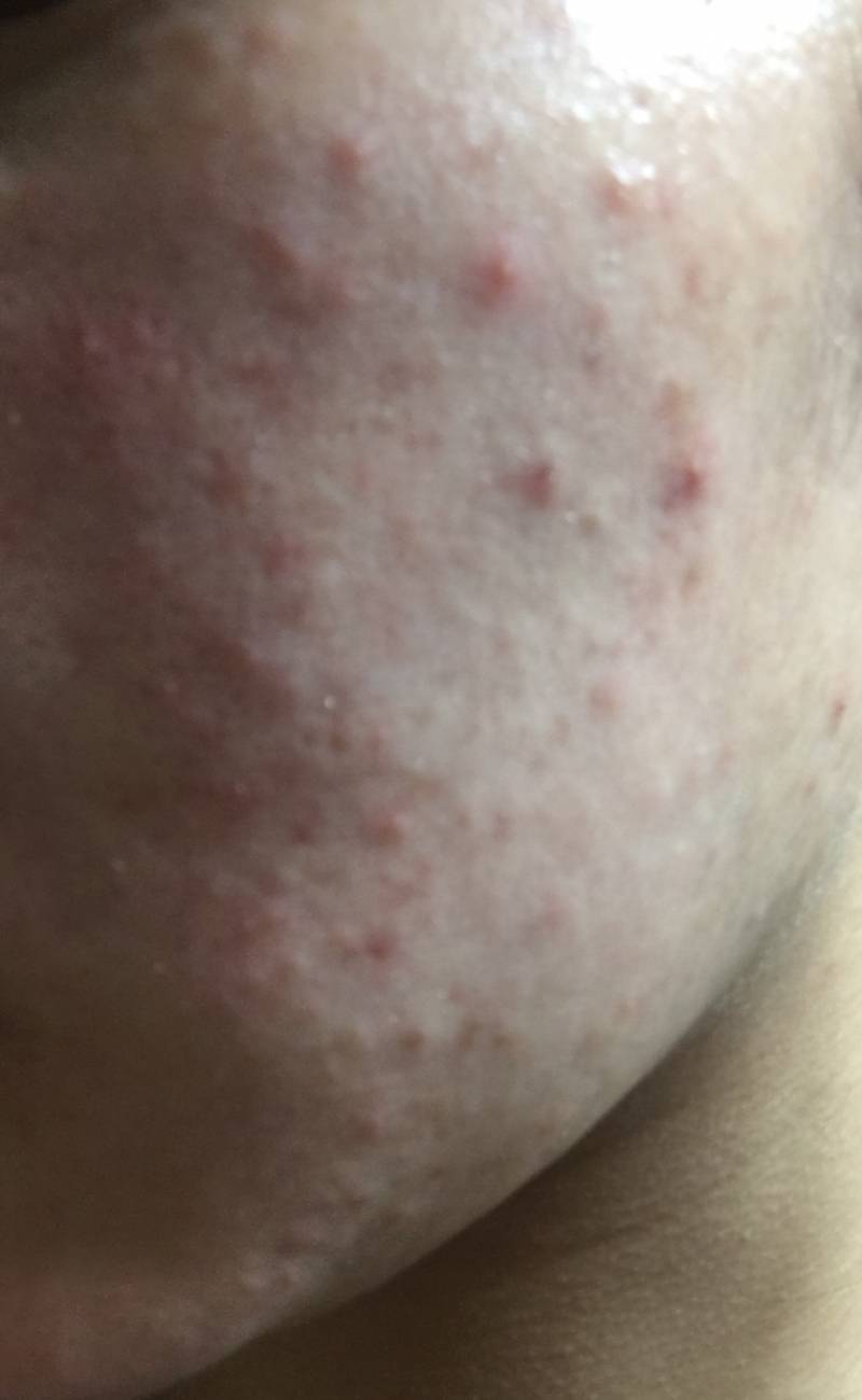 나 피부 완전 뒤집어졌어 학교 가기도 싫어 아떡해진짜로 | 인스티즈