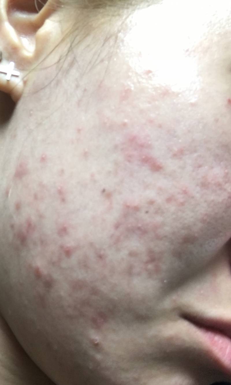 나 피부 완전 뒤집어졌어 학교 가기도 싫어 아떡해진짜로 | 인스티즈