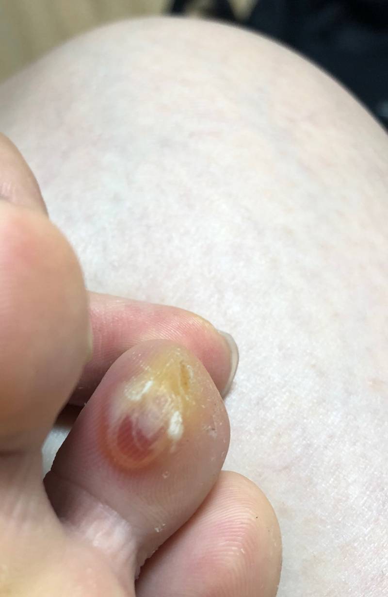 발가락에 자주 굳은살생기고 물집잡히는익들있어?혐혐혐오주의 징그러운거못보는사람 들어오지마! | 인스티즈