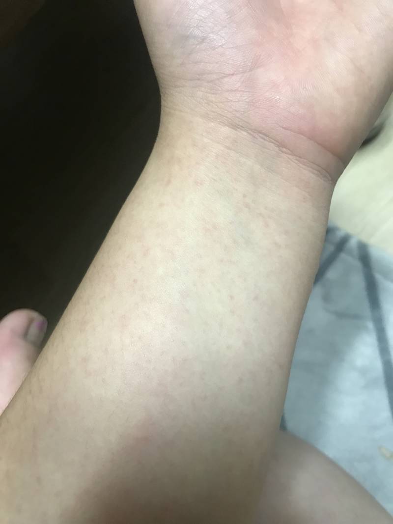 나 피부 왜이러지 ㅠ(사진주의) | 인스티즈