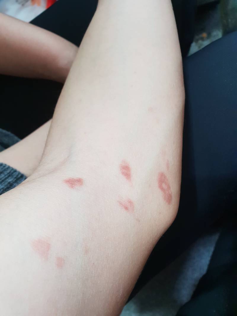 나 화상입었으(사진주의) | 인스티즈