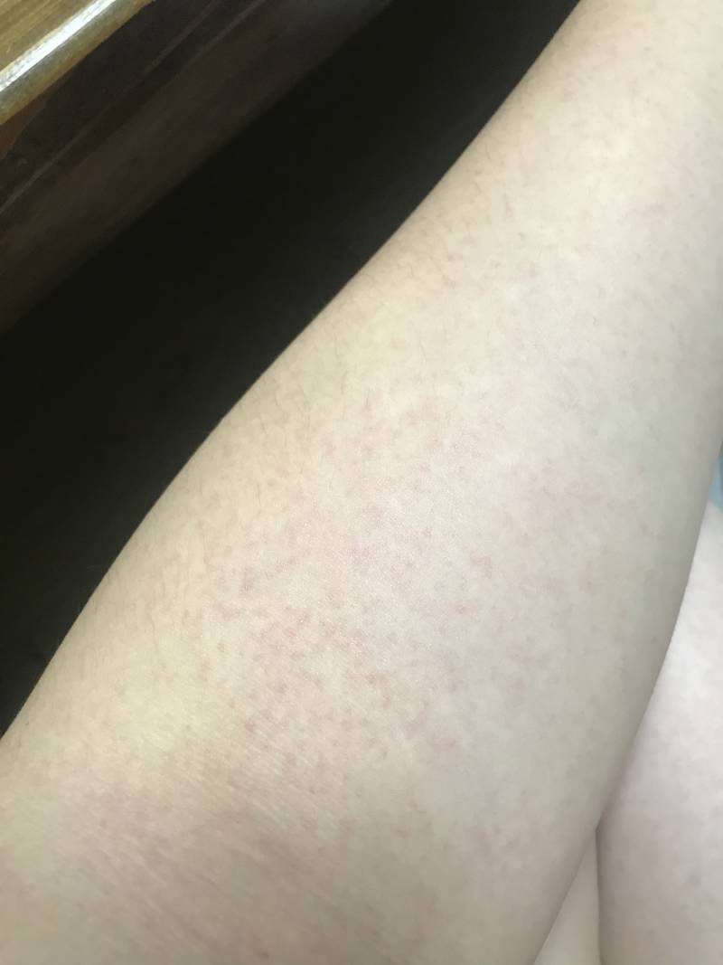 나 피부 왜이러지 ㅠ(사진주의) | 인스티즈