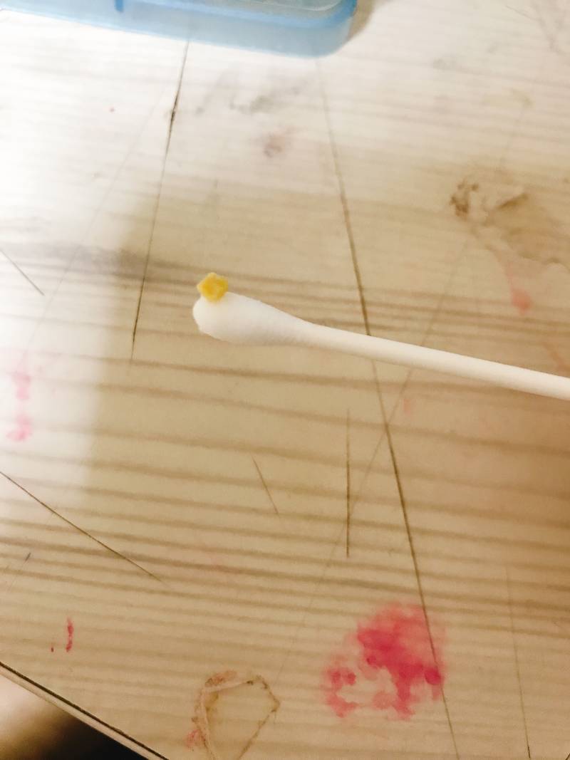 와 나 편도결석 진짜 1초만에 빼는 법 알아냈어(혐오주의) | 인스티즈