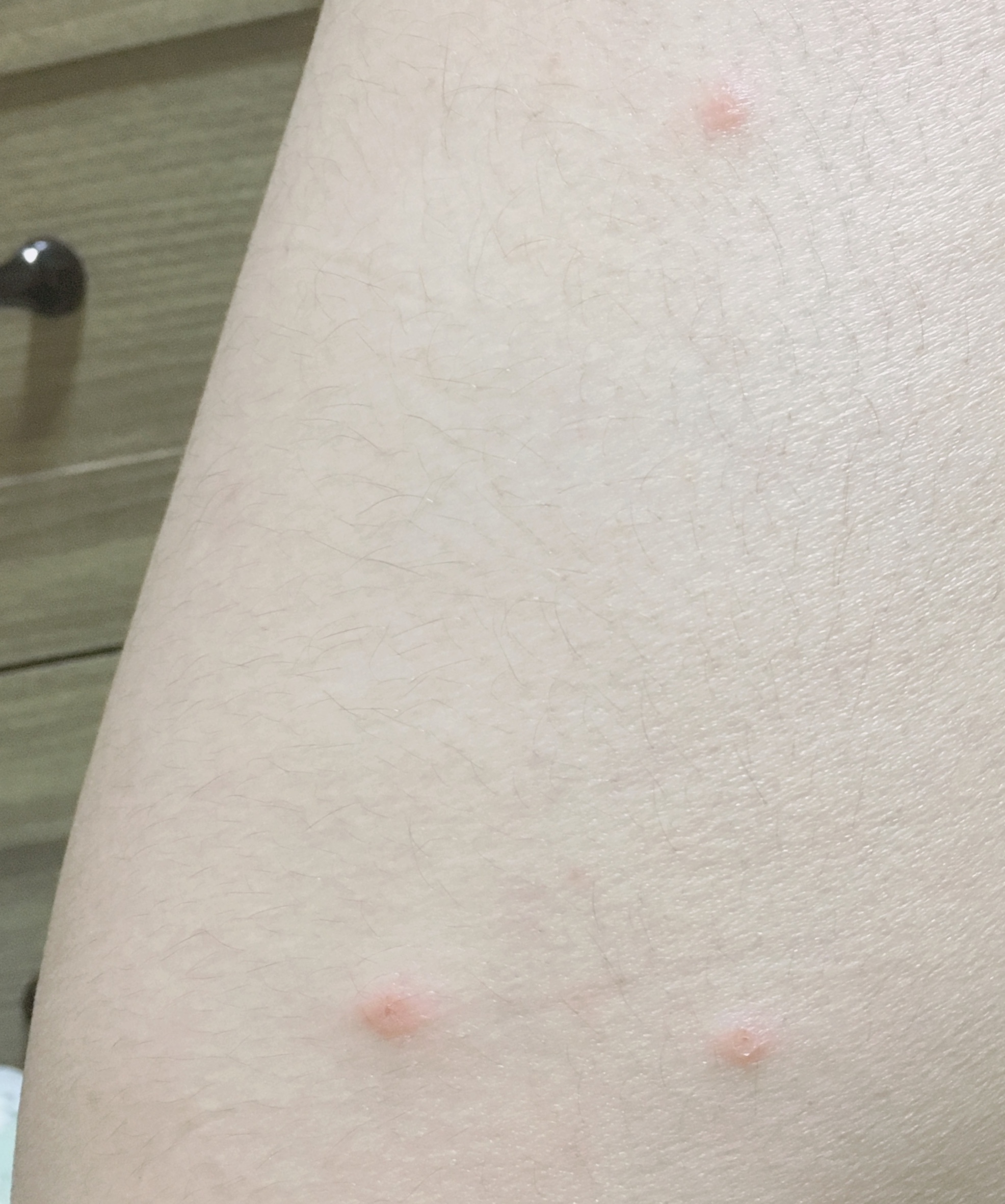 이거허벅지인데... 뭐난것같아..?ㅠㅜ(허벅지주의) | 인스티즈