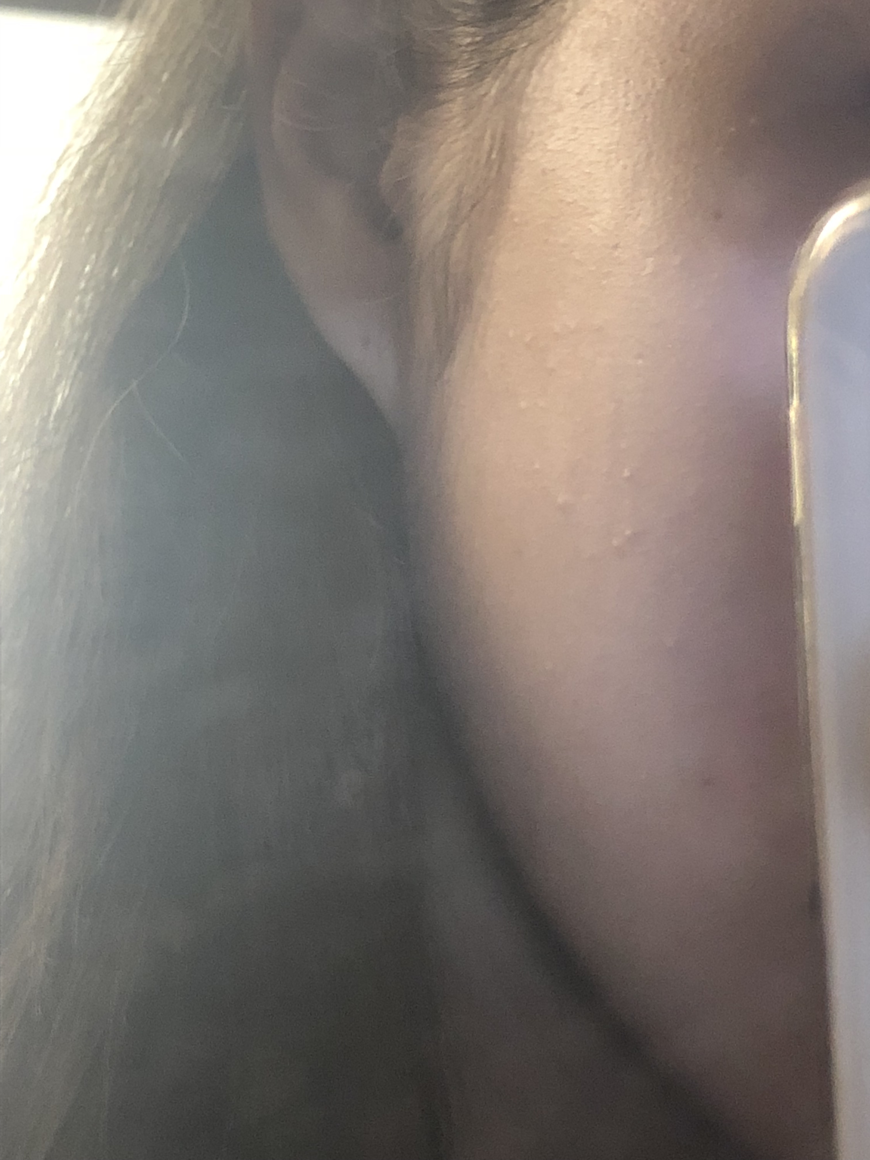 볼 옆에 좁쌀이 자꾸 생기는데ㅠㅠㅠㅠㅠ40 | 인스티즈