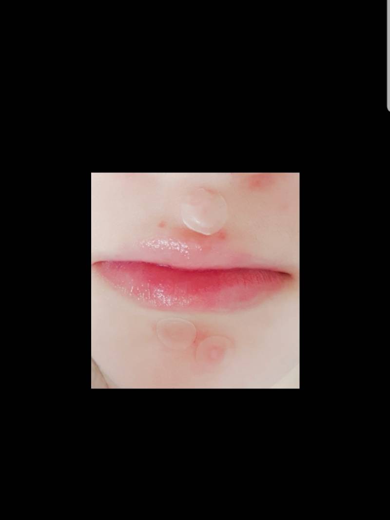 다른 쪽 피부는 깨끗한데 자꾸 턱이랑 인중에 여드름 나ㅠㅠ(사진주의) | 인스티즈