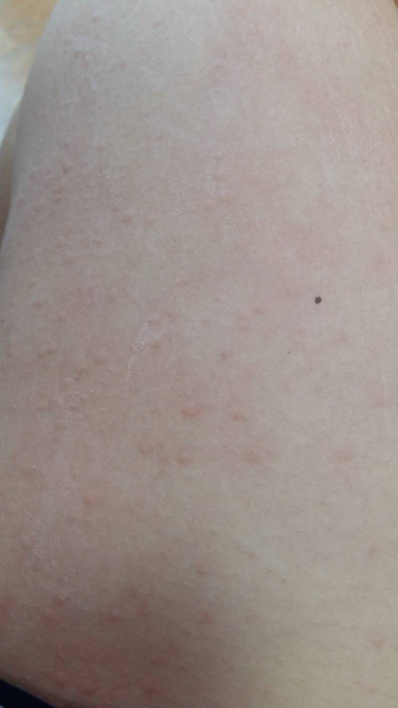 익인들아 내 다리 왜이래????? (ㅎㅇㅈㅇ) | 인스티즈