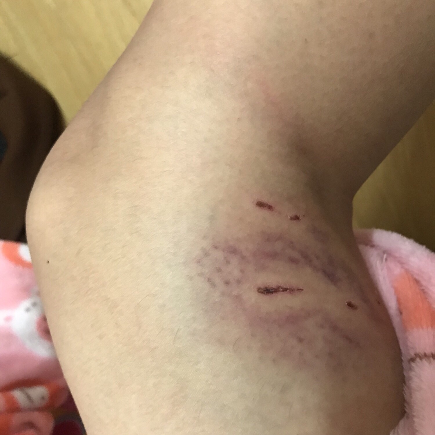 개한테 물리면 안되는 이유를 사진으로 설명한다 | 인스티즈