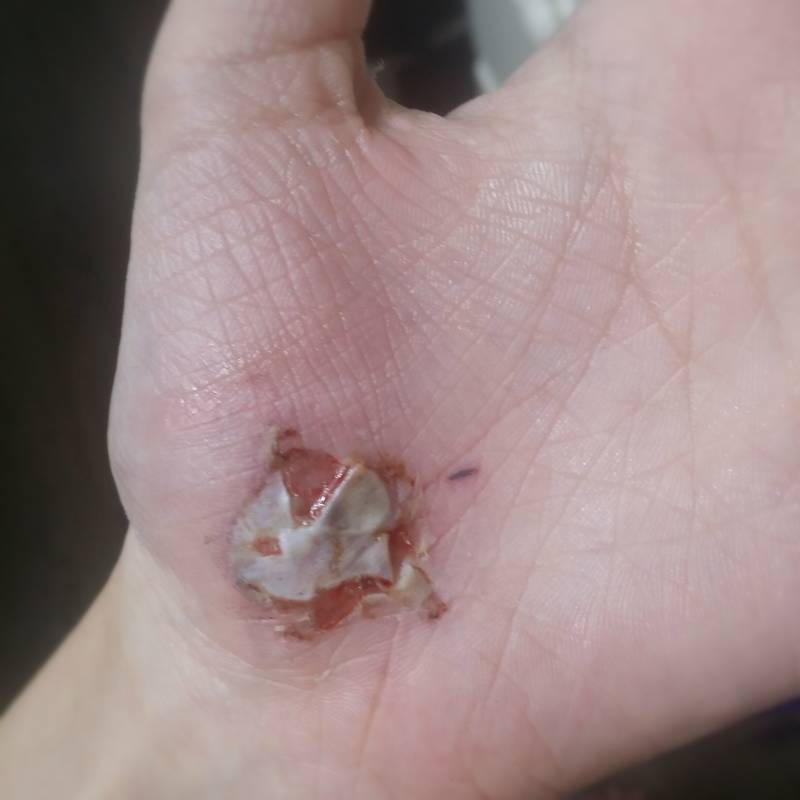 아스팔트에수 넘어져서 살껍질이 들떴ㄴ디 상처좀봐줄수있응까(혐오주의) | 인스티즈