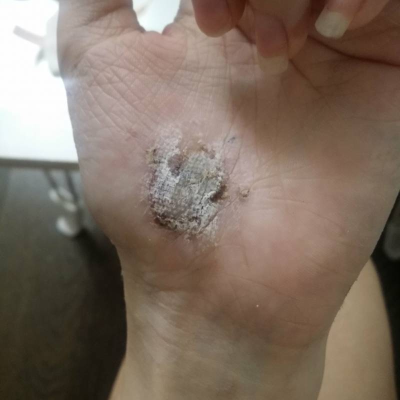 아스팔트에수 넘어져서 살껍질이 들떴ㄴ디 상처좀봐줄수있응까(혐오주의) | 인스티즈