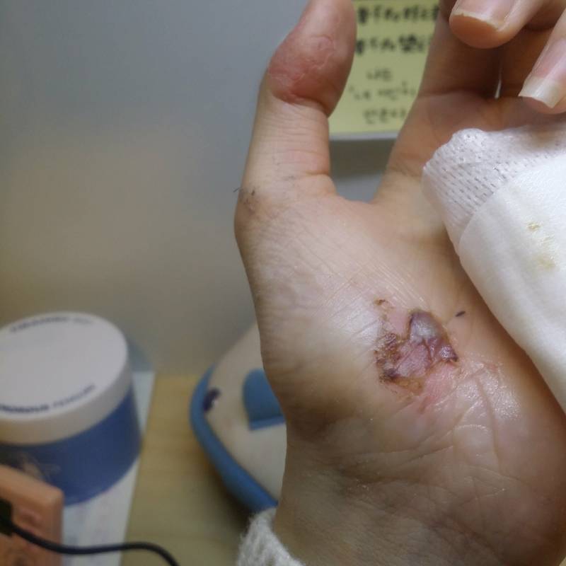 아스팔트에수 넘어져서 살껍질이 들떴ㄴ디 상처좀봐줄수있응까(혐오주의) | 인스티즈