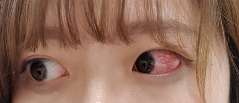 익선생님들 혹시 이것은결막염인가요??ㅇ | 인스티즈