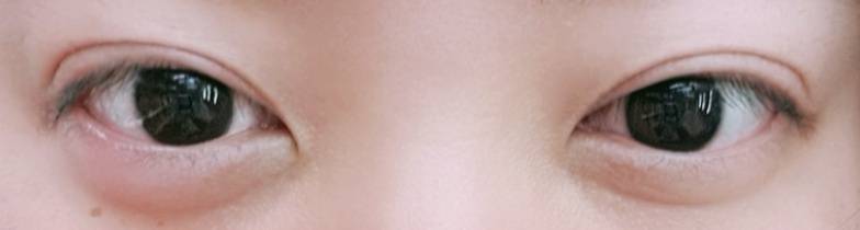 애교살 붓고 아픈디.. 왜이러지 | 인스티즈