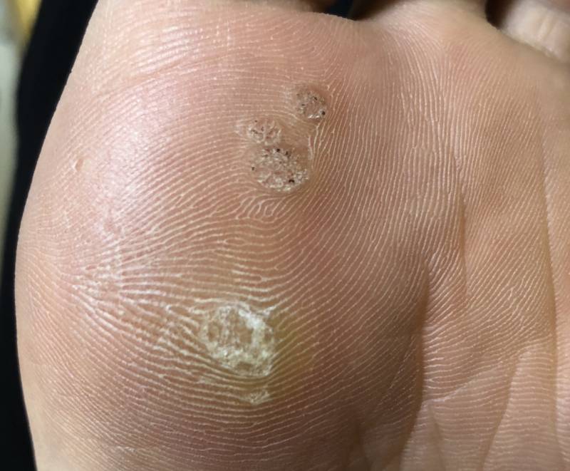 혹시 내 발 이거 왜이러는지 아는 사람...?(혐오주의) | 인스티즈