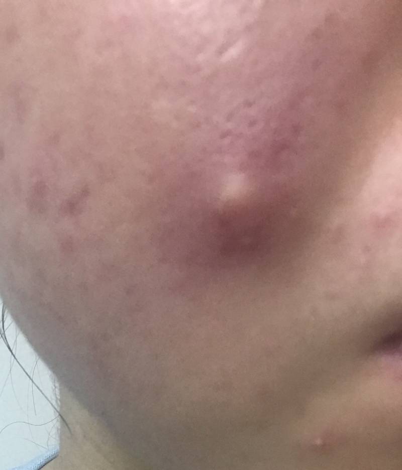 왕왕왕 큰 여드름 났는데 이런건 시간이 답이야???? (혐오주의) | 인스티즈