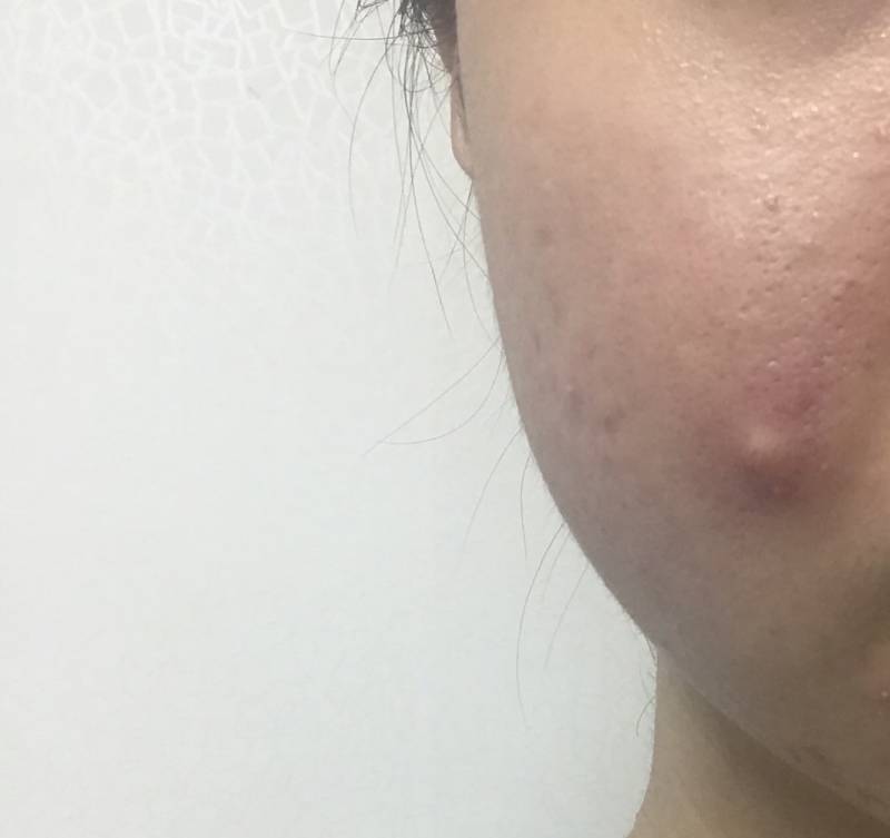 왕왕왕 큰 여드름 났는데 이런건 시간이 답이야???? (혐오주의) | 인스티즈