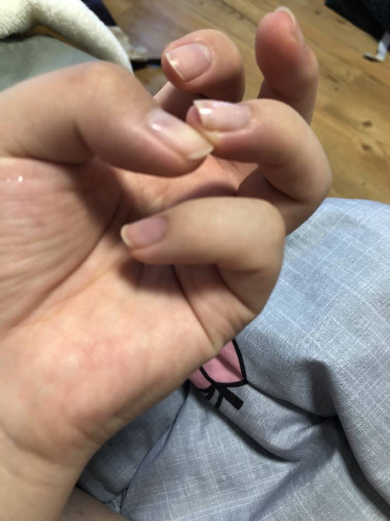 손가락이 이상한데 병원가야하나? 40 | 인스티즈