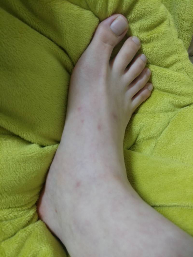 나처럼 모기흉터 안없어지는 사람있으?? | 인스티즈