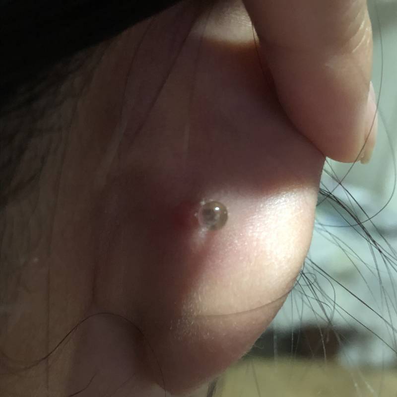 나 염증 생긴 거야?... | 인스티즈