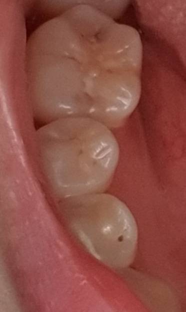 치과일 하는 익인있어?ㅜㅜ 이거충치일까..? 사진주의 | 인스티즈