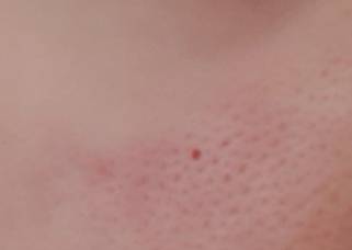 이런 피지는 어떻게 해야돼? 모공주의 ㅎㅇㅈㅇ | 인스티즈