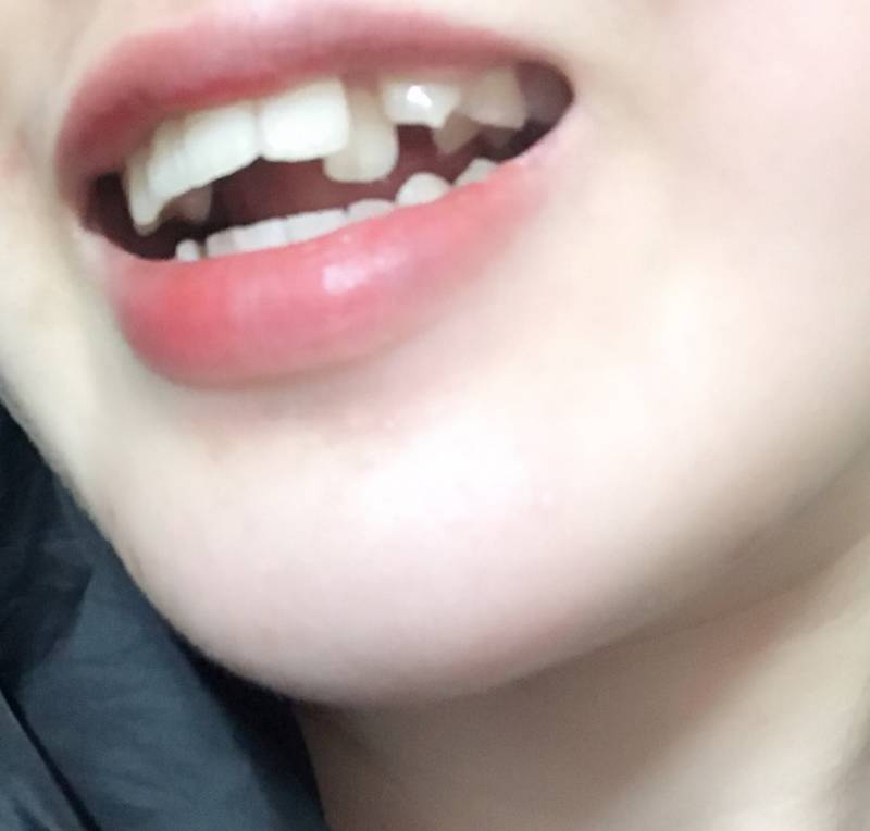 ㅎㅇㅈㅇ)ㅠㅠ 익두라 나 이빨 덧니 이거...치아성형? 라미? 가능할까 | 인스티즈