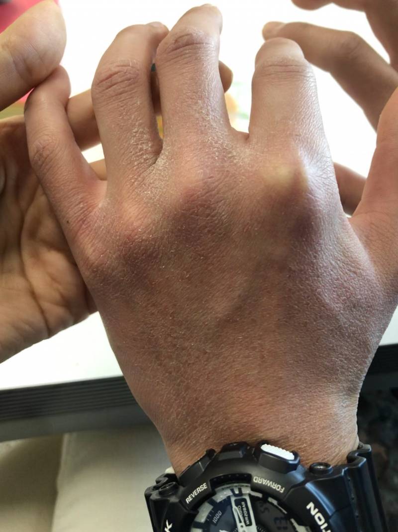 군인남친 손이 이렇게됏는데 ㅠㅠㅠㅠ동상일까.... | 인스티즈