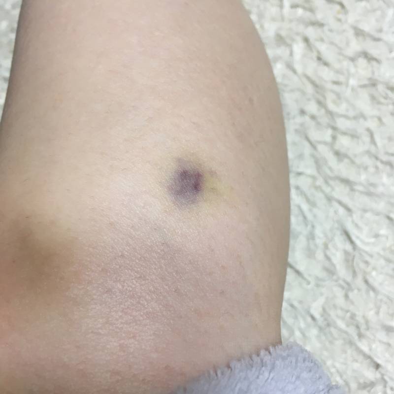 도대체 이런 시꺼먼 멍은 왜 멍들때 모르는거지 | 인스티즈