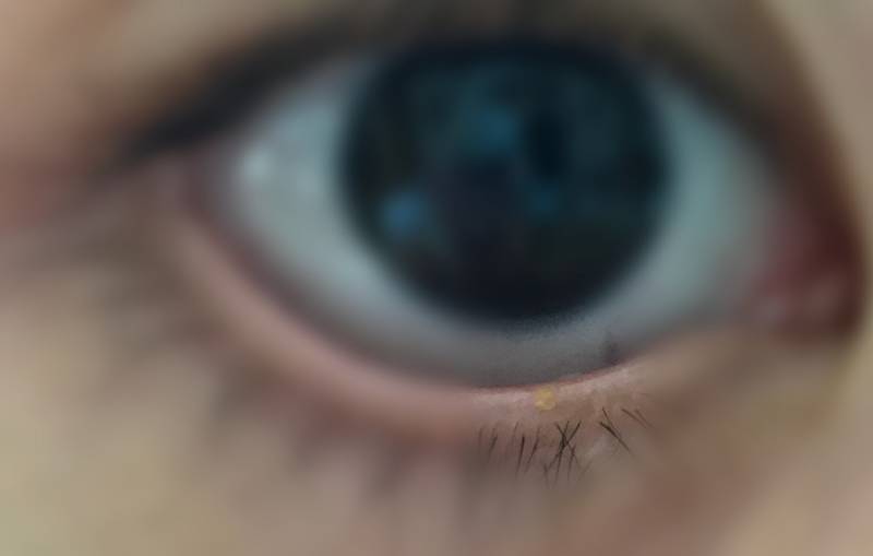 나 갑자기 눈에 이상한 게 났어 대체 이게 뭐야ㅠㅠ40 | 인스티즈