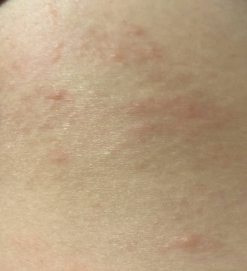 사진주의))몸에 두드러기인가 이거? 병원가야해? | 인스티즈