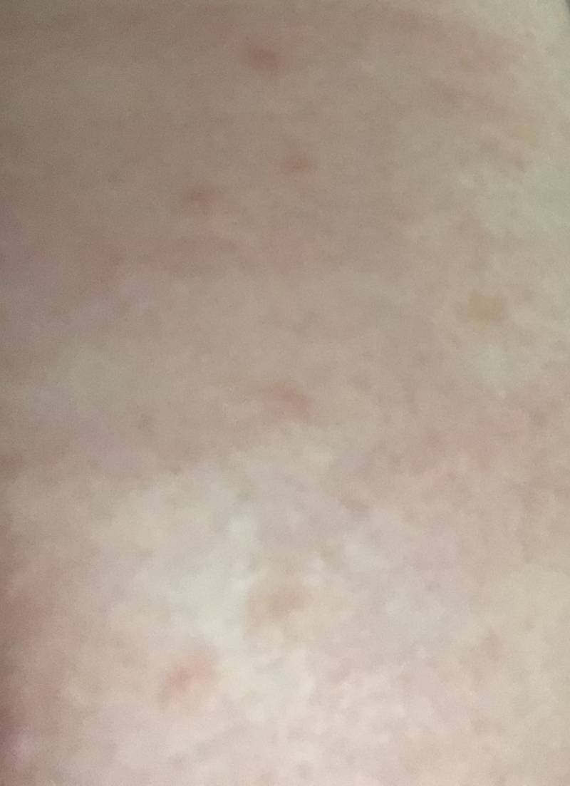 사진주의))몸에 두드러기인가 이거? 병원가야해? | 인스티즈