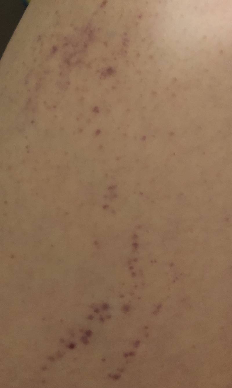 헐 익들아 내 허벅지 왜저러지...? ㅎㅇㅈㅇ | 인스티즈