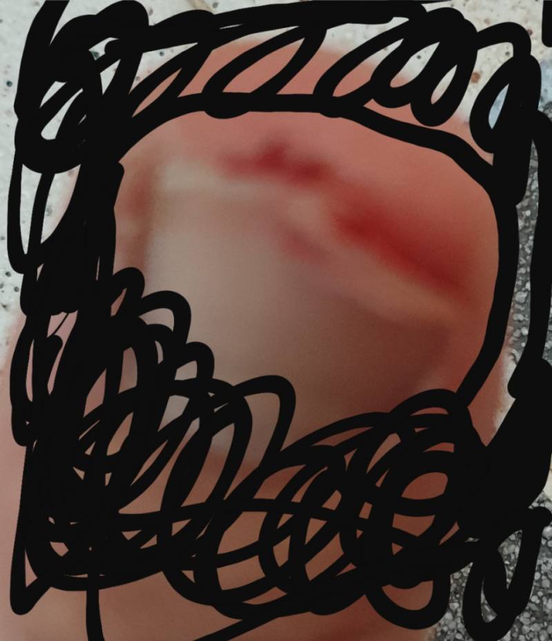 발톱 부러졌어ㅜㅜ 이거 어떡해?ㅠㅠ | 인스티즈