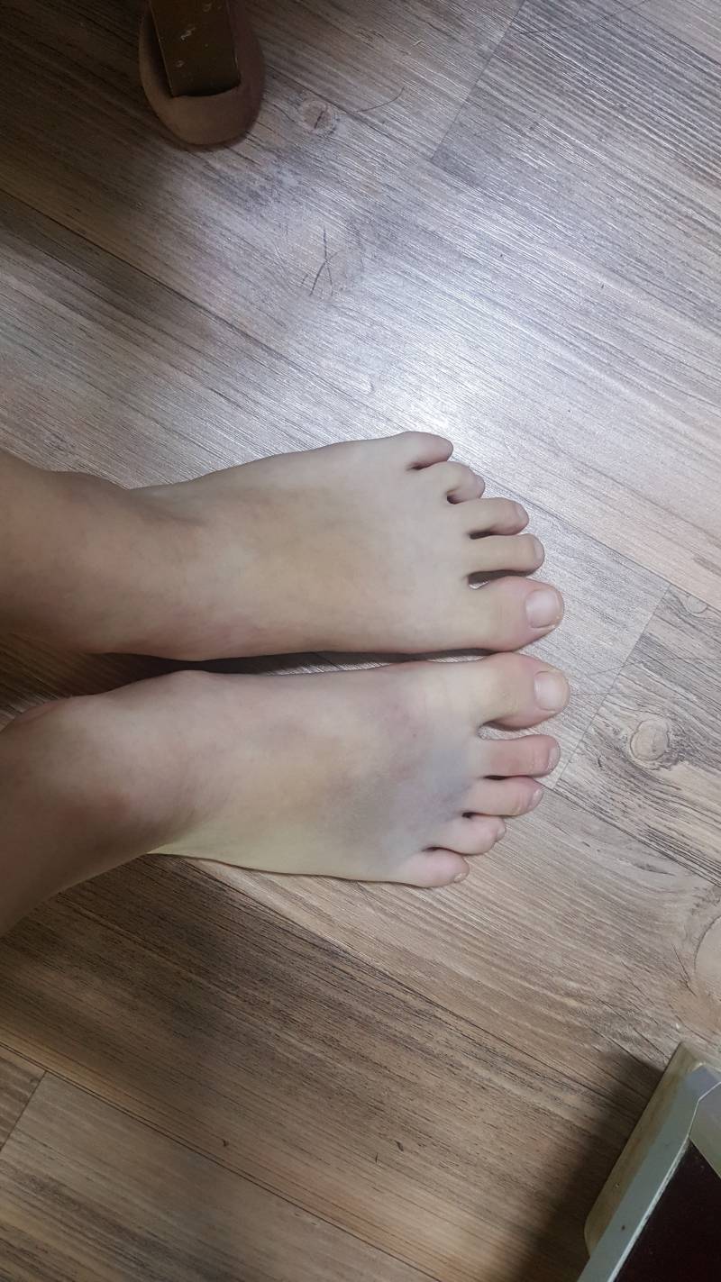 익들아 이거 발가락 골절은 아니겠지?ㅠㅠ 40 | 인스티즈