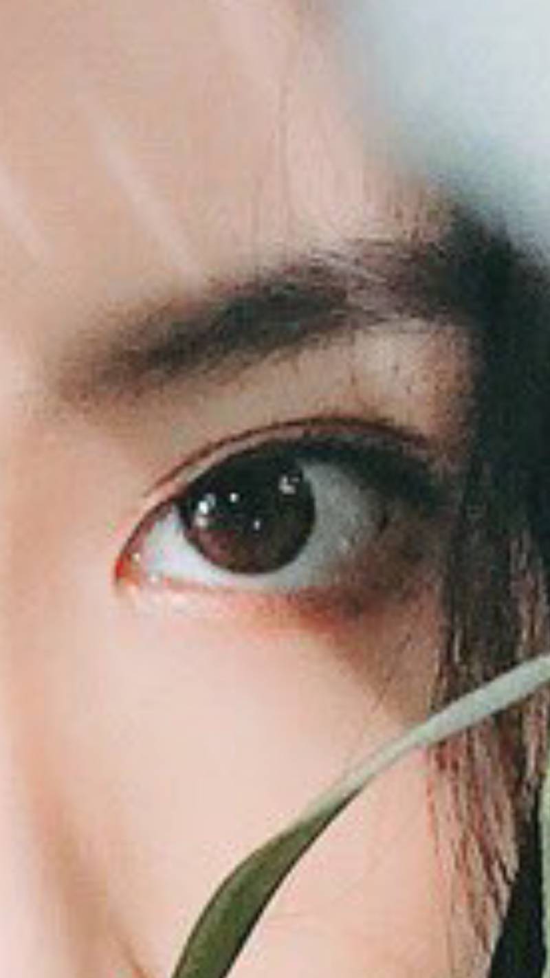 이런쌍커풀은 어떤라인이고 어떻게 수술해야 만들어져?? | 인스티즈